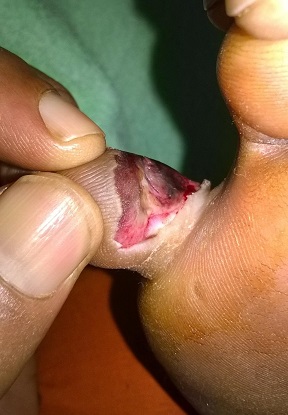 Starting of Ulceration