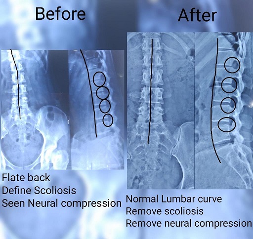 Scoliosis